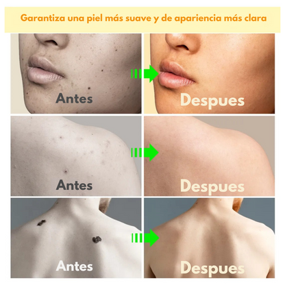 Spray Bee Venom – Elimina verrugas de forma segura, sin dolor ni cicatrices